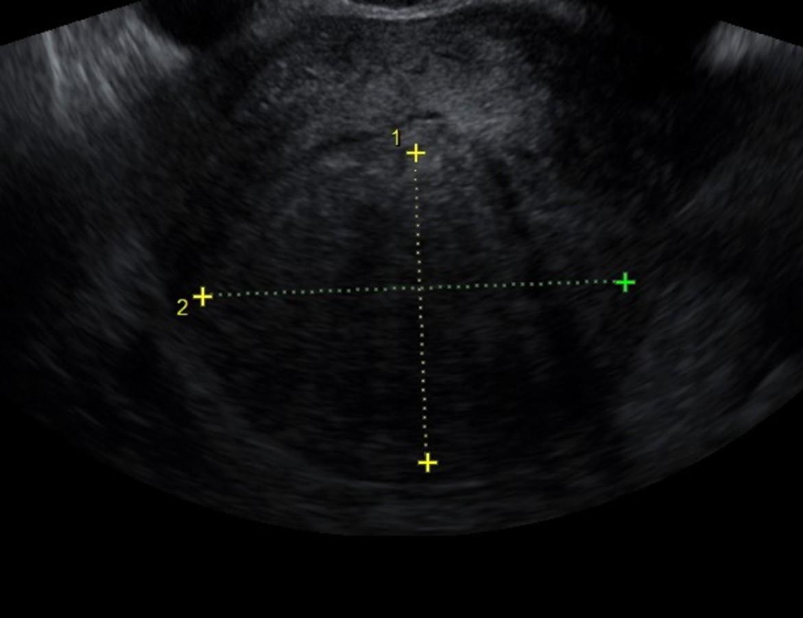 Ultrasound Guided RFA