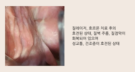 질레이저 치료 후 질벽 상태